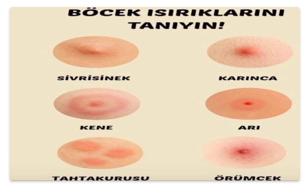 Kene ve Diğer Böcek Isırmaları Durumunda Ne Yapmalıyız